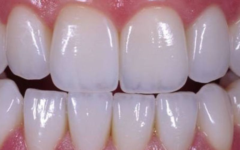 Răng sứ EMAX