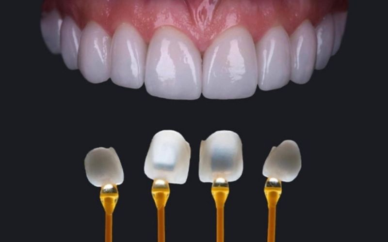 Răng sứ EMAX