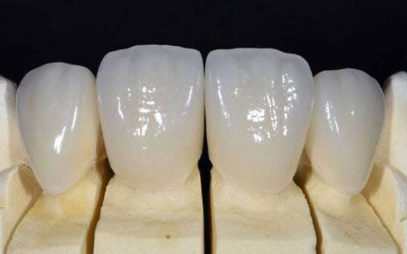 Răng sứ EMAX